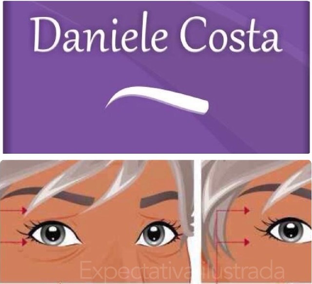 Blefaroplastia sem cortes - pálpebras caídas